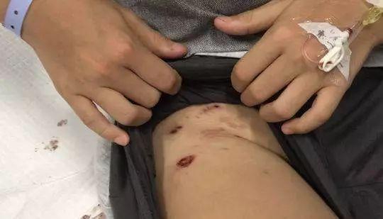 新澳2025今晚开奖结果和7岁男孩遭3只犬撕咬与7岁男孩遭3只犬撕咬怎么办